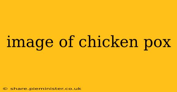 image of chicken pox